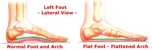 FitOldDog introduces the roll of flat feet in Plantar Fasciitis